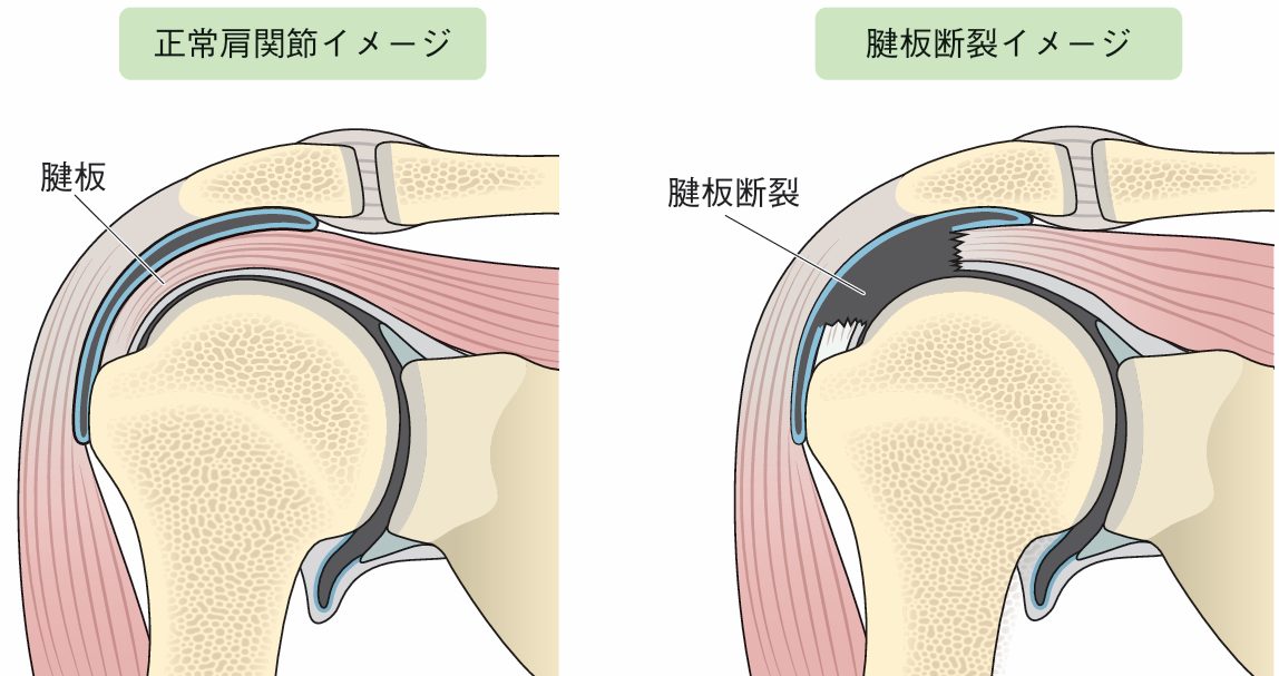 四十肩、五十肩の特徴3選！