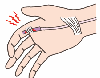 ばね指の特徴３選