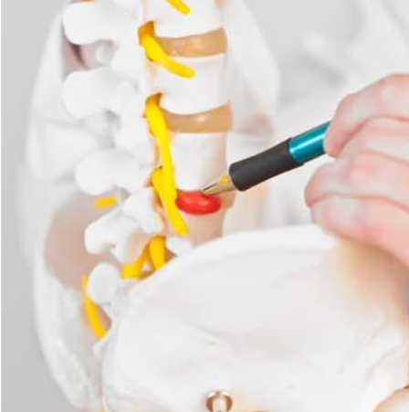 腰椎椎間板ヘルニア