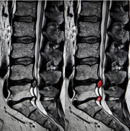 腰椎椎間板ヘルニアの診断