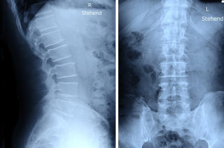 変形性腰椎症の診断
