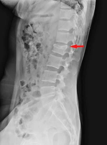 腰椎圧迫骨折の治療