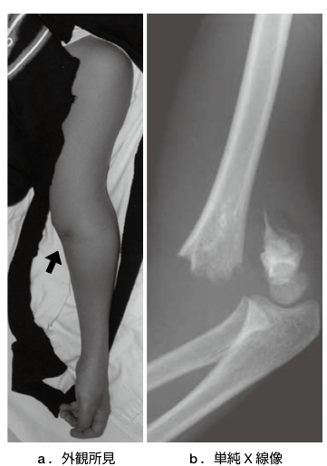 肘の骨折(上腕骨顆上骨折)