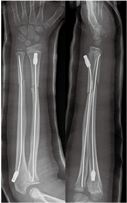 ギプスによる保存治療