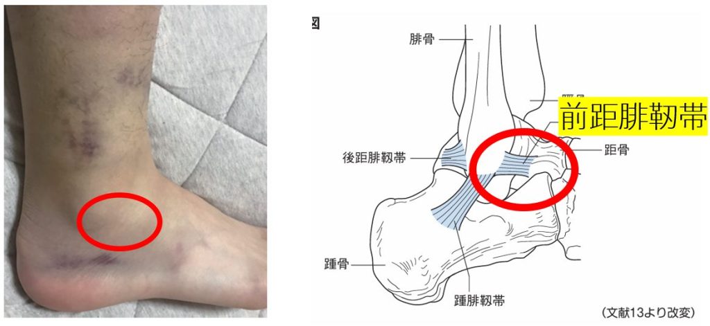 骨折の有無や靭帯損傷の程