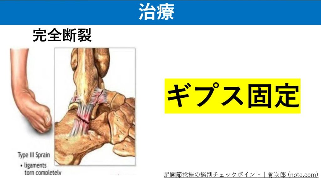 ギプスによる外固定