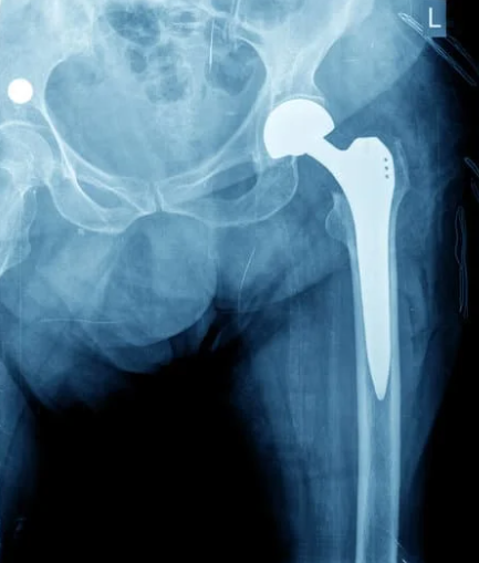 人工股関節
