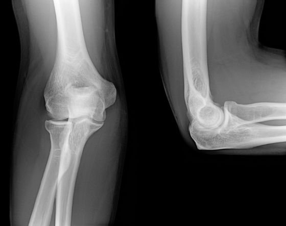 肘部管症候群の診断