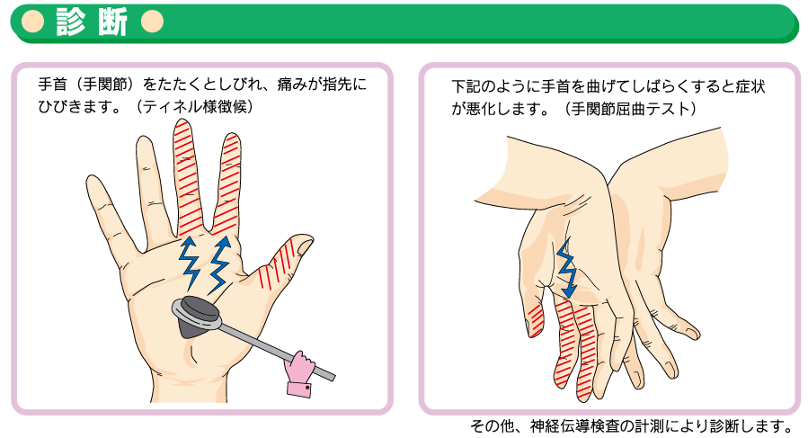 手根管症候群の診断