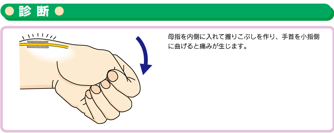 ドケルバン病の診断