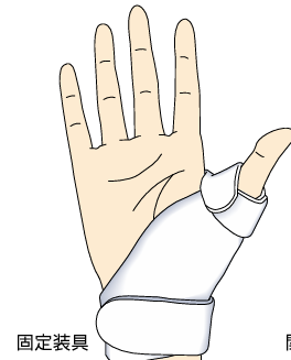 母指CM関節症の治療