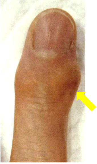 へバーデン結節