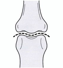 へバーデン結節の診断