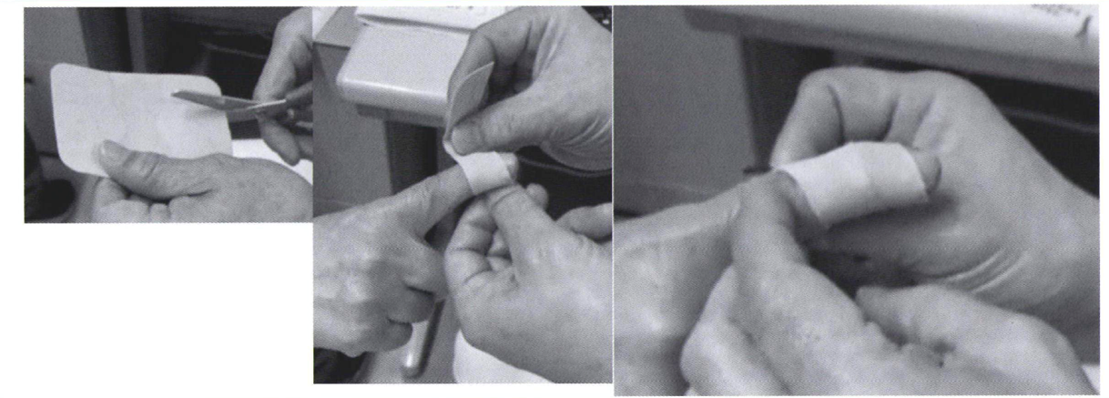 へバーデン結節の治療