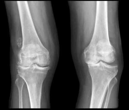 変形性膝関節症の診断