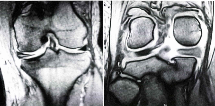半月板損傷の診断
