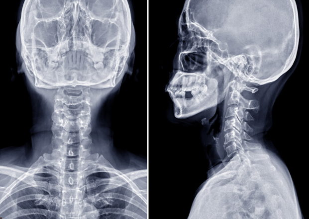 ストレートネック・スマホ首の診断