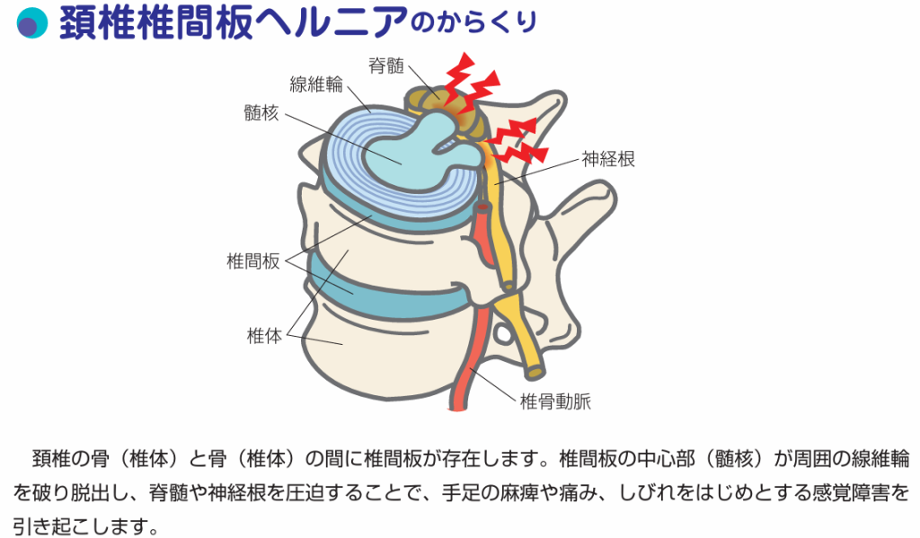 頚椎椎間板ヘルニア