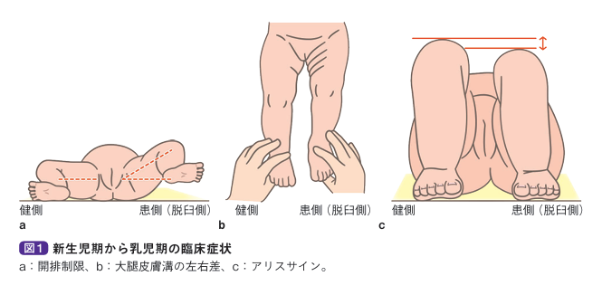 新生児期からの乳児期の臨床症状