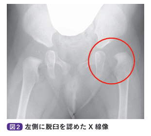 左側に脱臼を認めたX線像