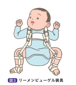 リーメンビューゲル装具