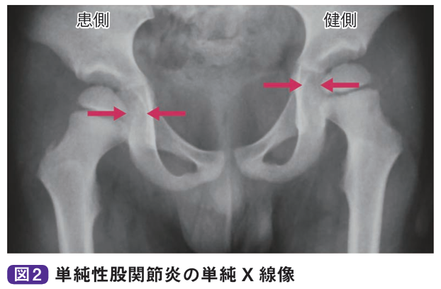 単純性股関節炎