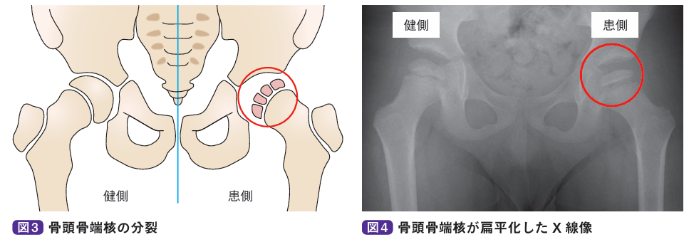 骨頭骨端核の分裂