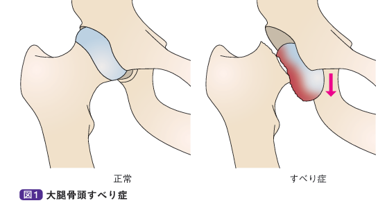 大腿骨頭すべり症