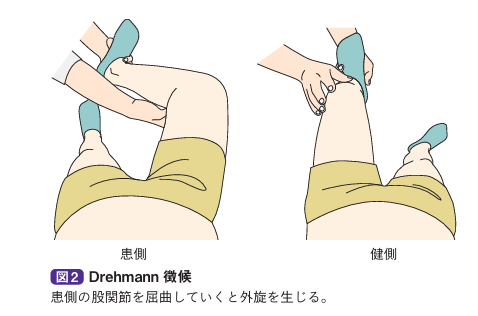 Drehmann微候