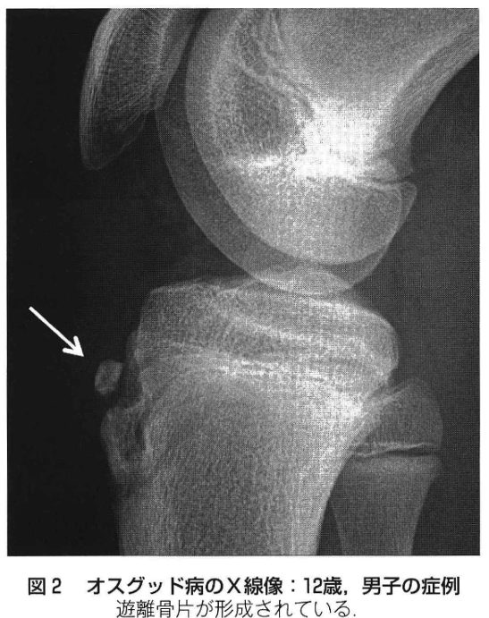 オスグッド病のX線像