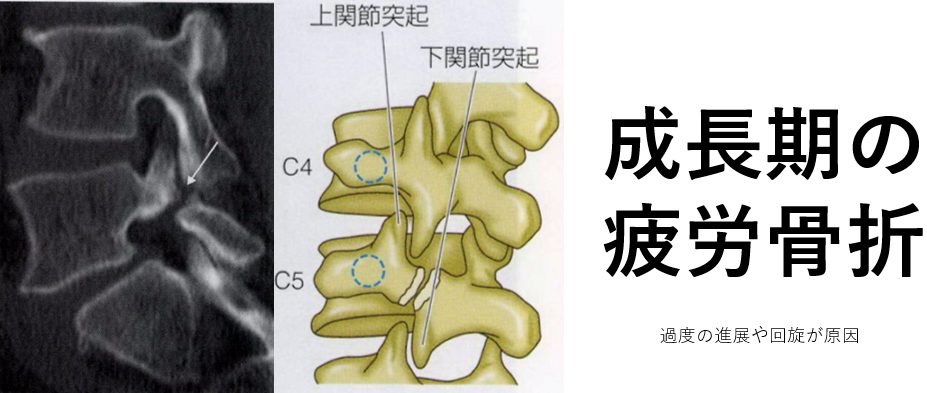 成長期の疲労骨折