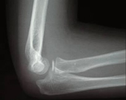 肘のレントゲン