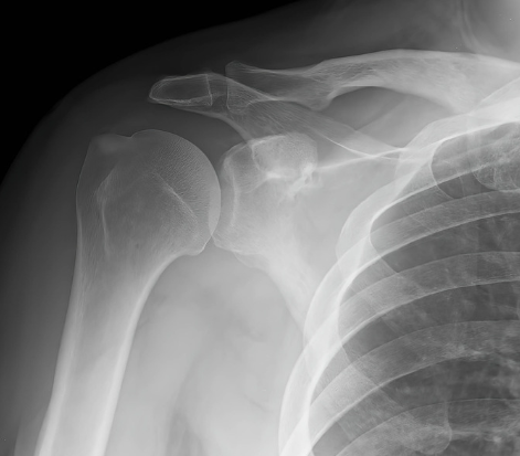 五十肩・肩周囲炎の診断