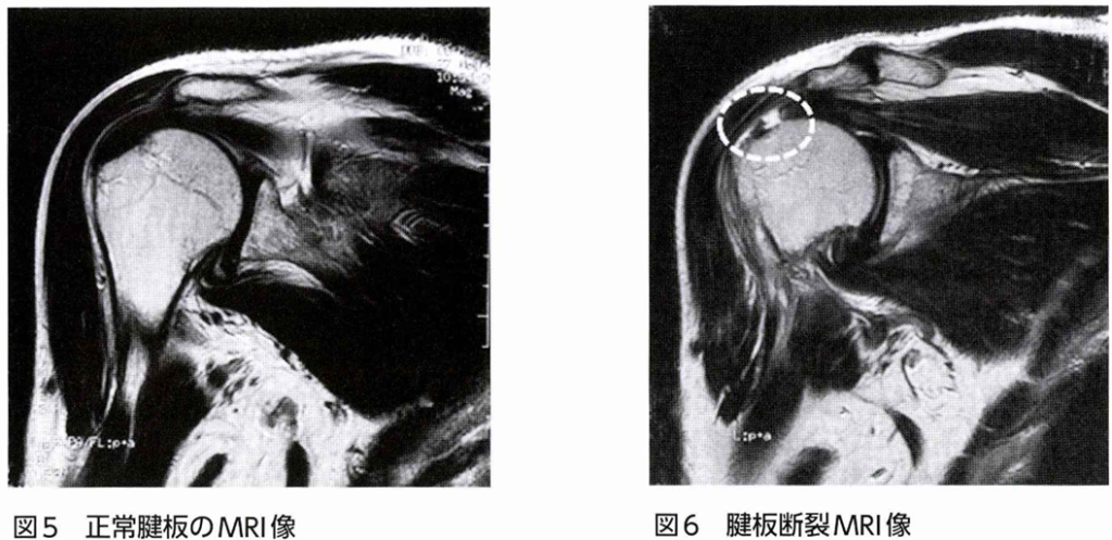 腱板断裂の診断