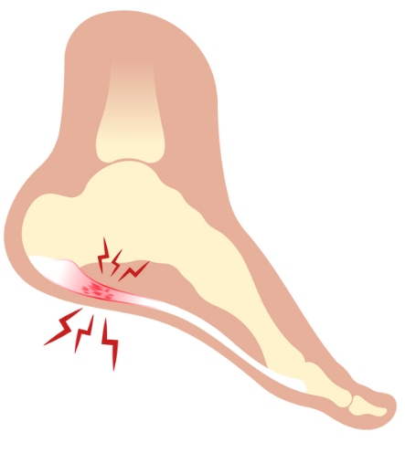 【2月27日】朝の一歩が痛い…それは足底筋膜炎かもしれません