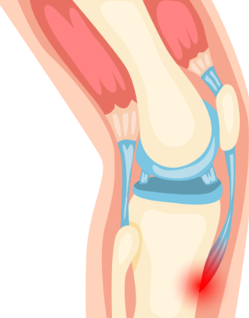 【整形外科医が解説】オスグッド病とは？原因・診断・治療・予防まで詳しく解説
