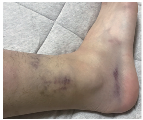 足首をひねった後に腫れと皮下出血がみられる状態
